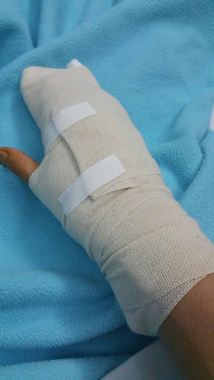 손가락 거대세포종